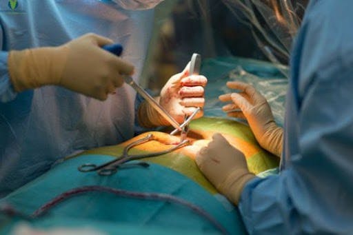 An Overview of Common Surgical Spine Procedures